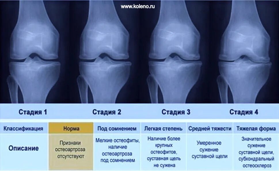 Остеоартроз 1 2 степени коленного сустава. Артроз коленного сустава 2 степени рентген. Артроз коленного сустава 3 степени рентген. Деформирующий остеоартроз коленного сустава рентген. Деформирующий гонартроз коленного сустава 2-3 степени.