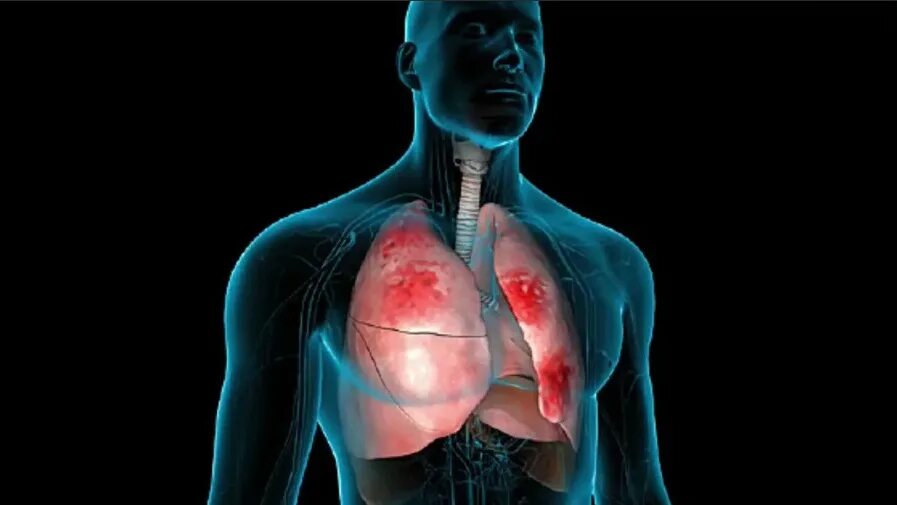 воспаление легких видео