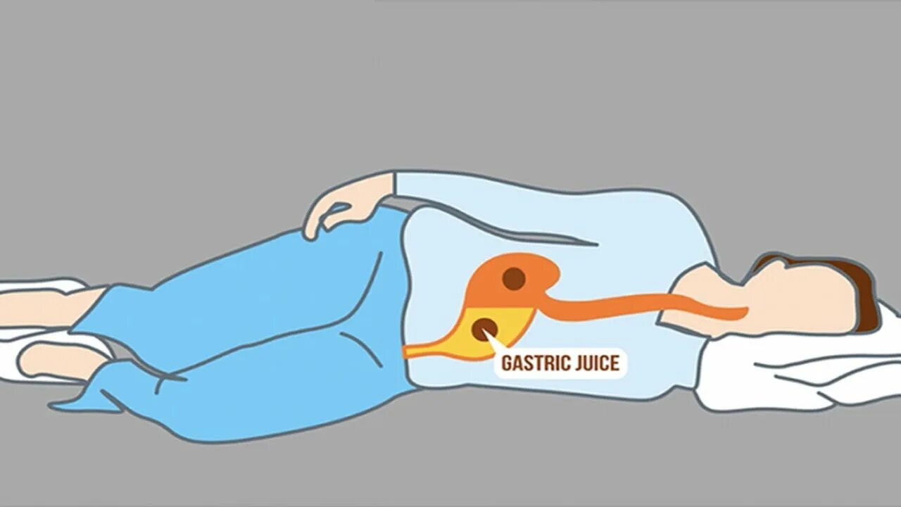 Кровать при гэрб. Рефлюксная подушка. Положение на левом боку. Кровать с приподнятым изголовьем при гэрб. Как спать при гэрб.