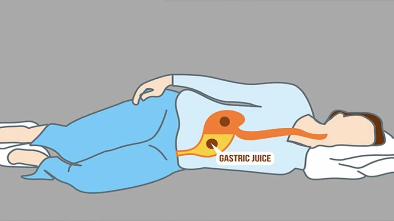 Ночной рефлюкс. Спать на левом боку. Поза для сна при ГЭРБ. Поза для сна на левом боку. Поза для сна при изжоге.