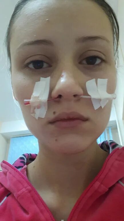 Прокол носа при гайморите видео. Прокол носа от гайморита.
