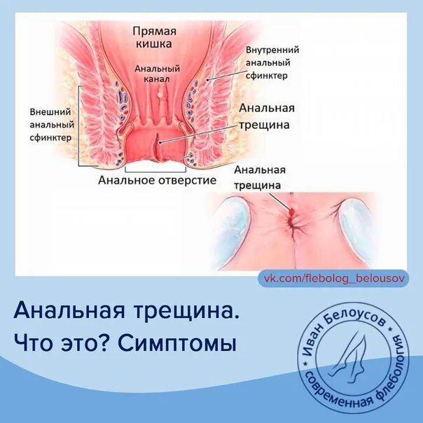 Анальная трещина заднего прохода. Хроническая анальная трещина. Наружная трещина заднего прохода.