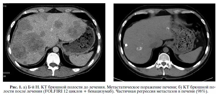 Метастатическое поражение печени мрт. Основной причиной метастатических опухолей печени является тест. Препараты химиотерапии при онкологии печени. После химиотерапии метастазы печени. Метастатическое поражение печени.