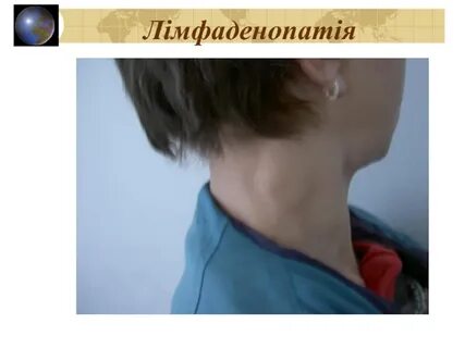 Заболели лимфоузлы
