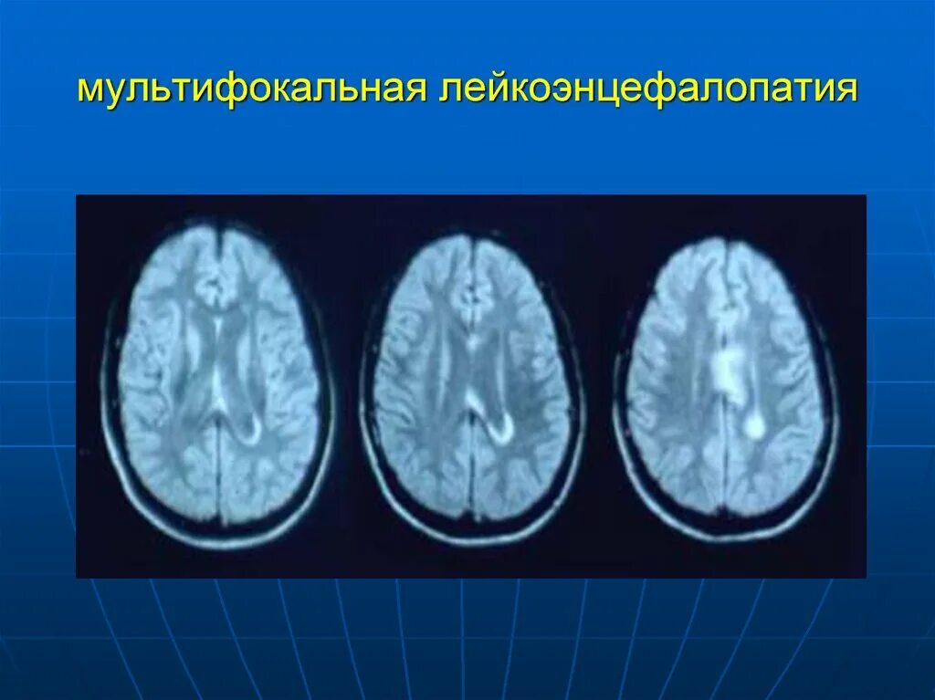 Лейкоэнцефалит