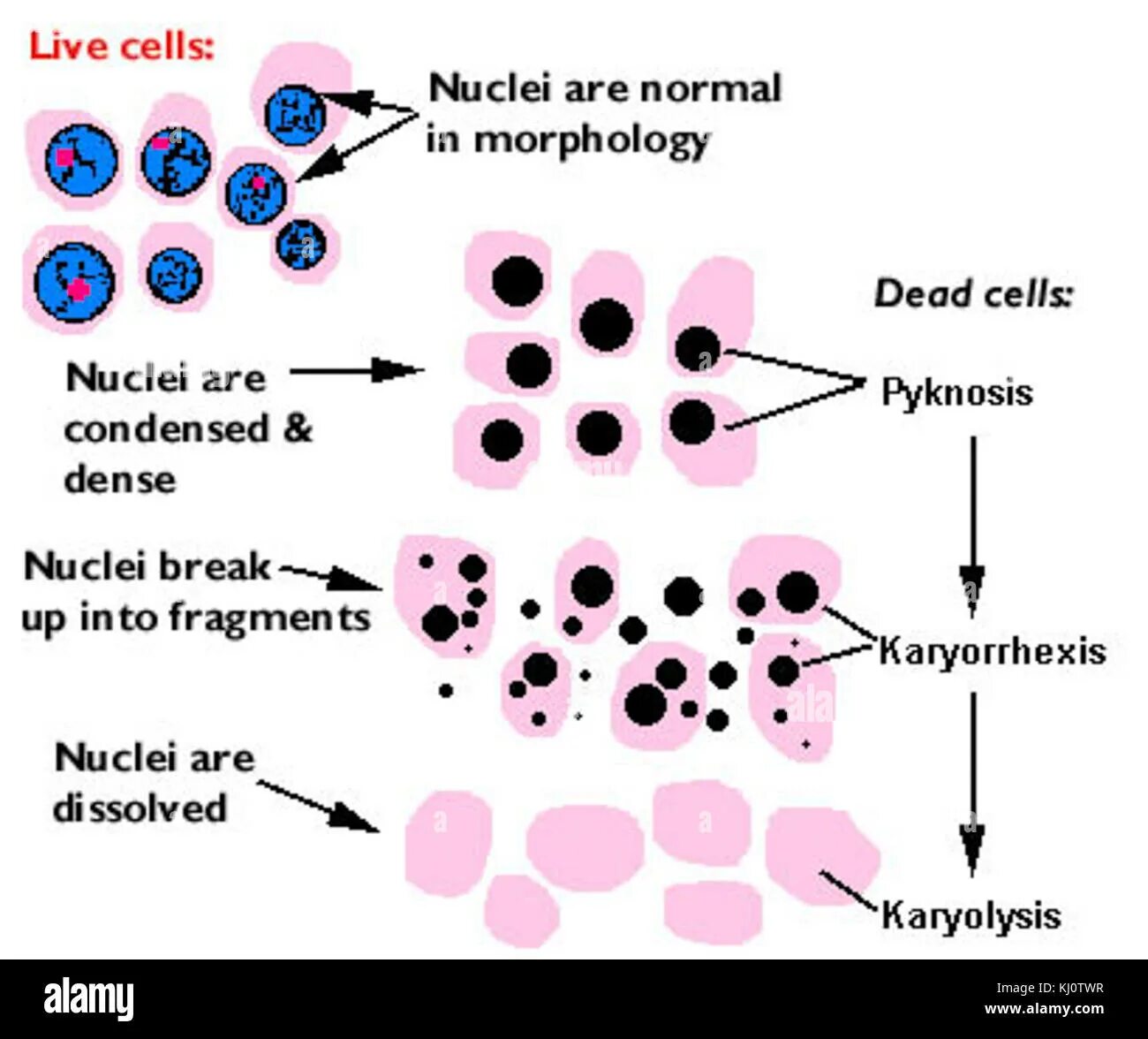 Кариопикноз это. Кариопикноз кариорексис. Кариопикноз кариорексис кариолизис некроз. Кариопикноз это в патологии. Пикноз клетки.