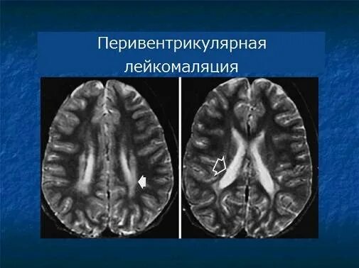 Ишемическая головного мозга новорожденного. Перивентрикулярная лейкомаляция мрт. ПВЛ перивентрикулярная лейкомаляция. Перивентрикулярная лейкомаляция у детей мрт. Лейкомаляция перивентрикулярная новорожденного.