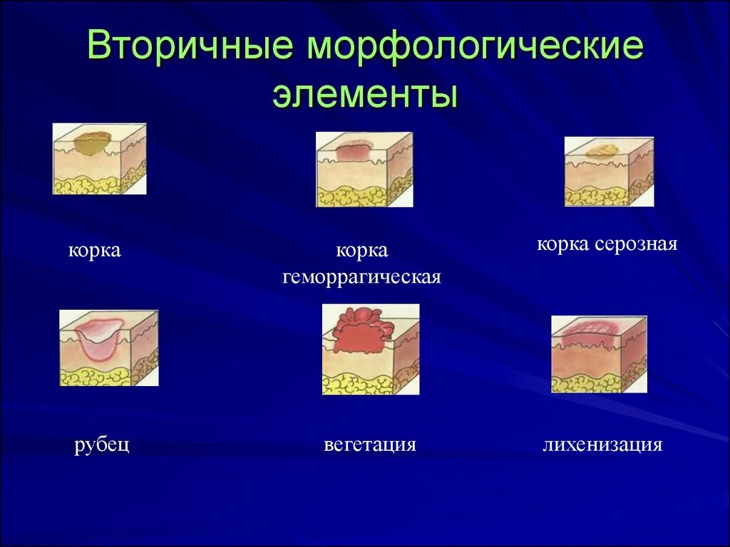 Вторичные элементы поражения