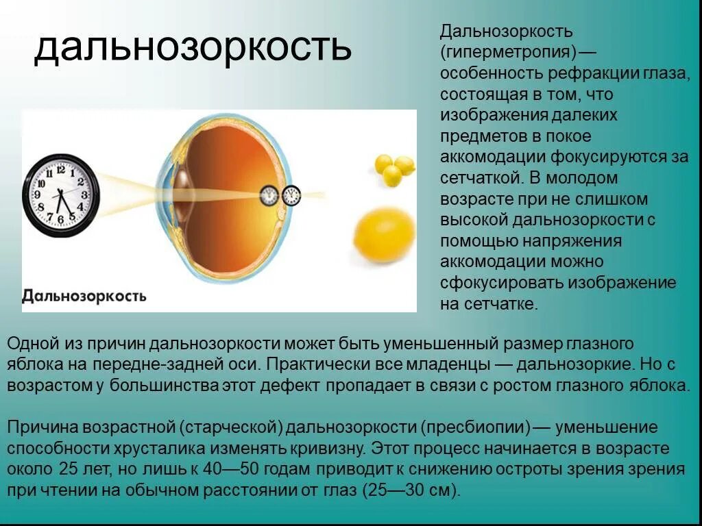 Причины заболевания зрения. Миопия дальнозоркость астигматизм. Гиперметропия высокой степени рефракция. Дальнозоркость (гиперметропия). Заболевание дальнозоркость.