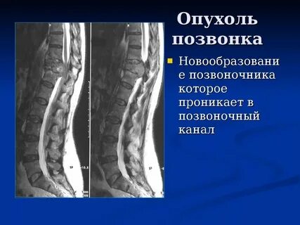 Отек на спине