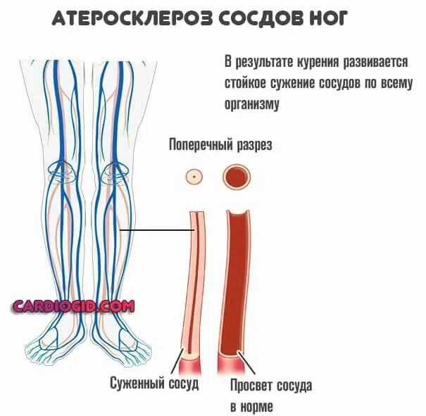 Колики в ногах причины. Стеноз сосудов что это нижних конечностей артерий. Сужение просвета кровеносных сосудов.