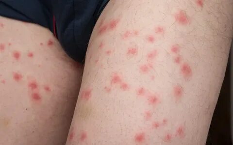 Могут ли клопы кусать людей днем? ДезИнСити Дзен