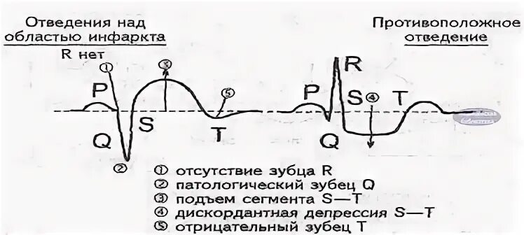 Q инфаркт экг