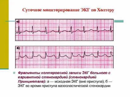 Стенокардия на экг