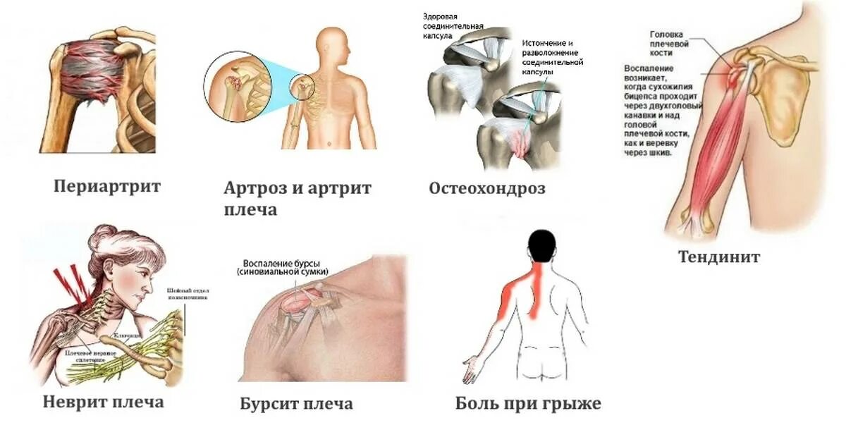 Резкая сильная боль в плечевом суставе. Плечевой сустав. Больное плечо. Дискомфорт в плечевом суставе.