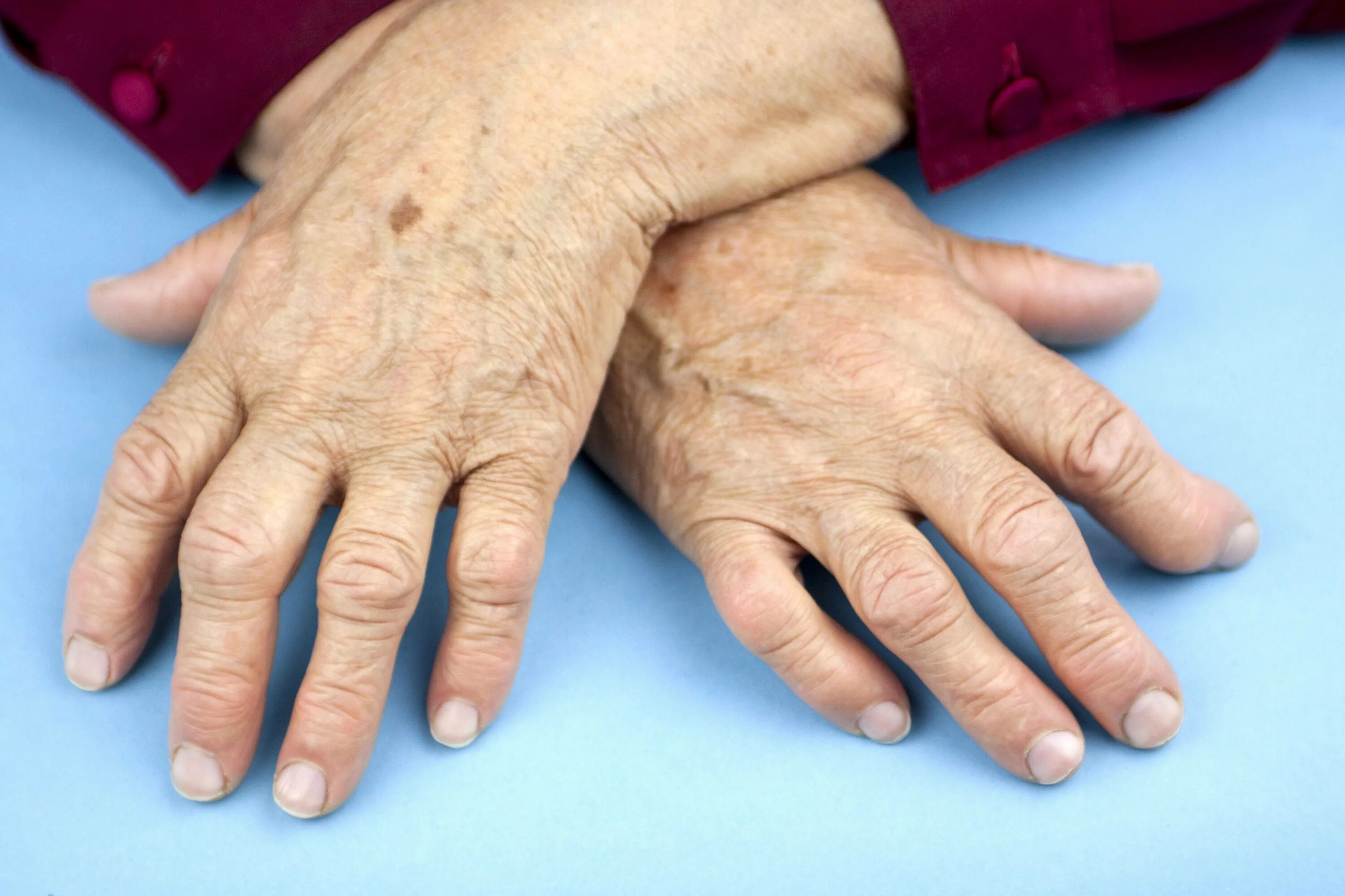 Суставы пальцев сильно. Серопозитивный ревматоидный артрит. Ревматизм и ревматоидный полиартрит.