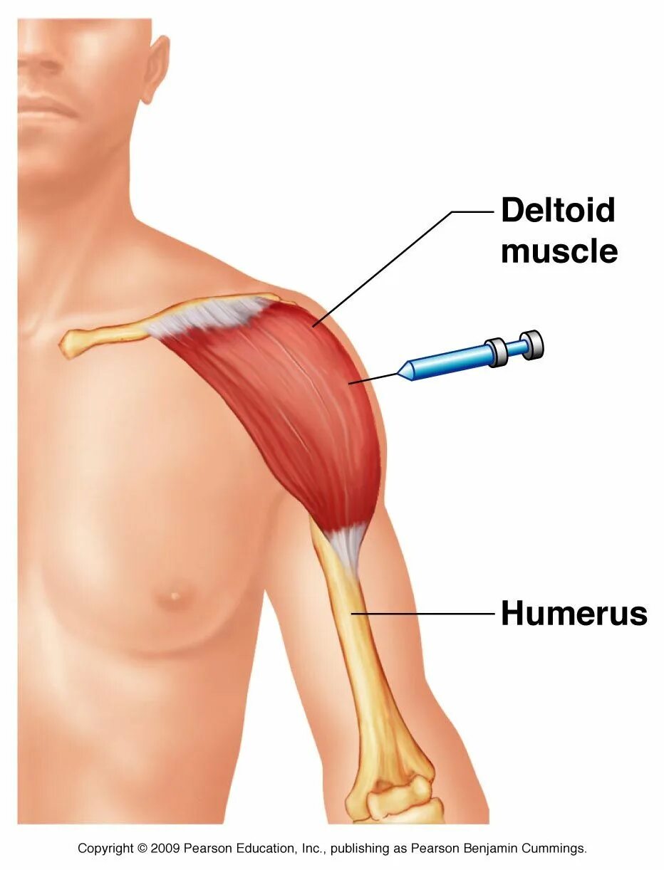 Что колят для мышц. Дельтовидная мышца плеча прививка. Укол в дельтовидную мышцу. Укол в дельтовидную мышцу плеча. Внутримышечно в дельтовидную мышцу плеча.