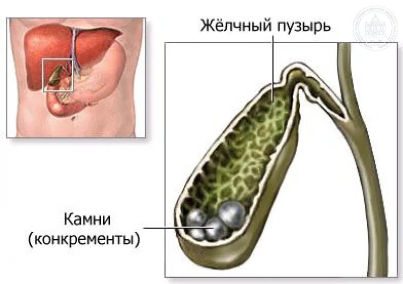 Камни при жкб. Желчекаменная болезнь холелитиаз. Желчный пузырь в разрезе. Желчный пузырь желчнокаменная болезнь. ЖКБ конкременты желчного пузыря.