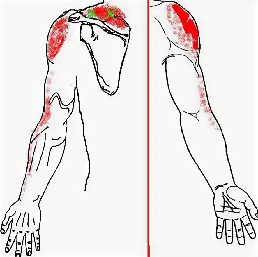 Болит плечо левой руки ноющая. Миофасциальный синдром. Миофасциальный синдром руки. Триггерные точки локтевого нерва. Миофасциальный синдром кисти.