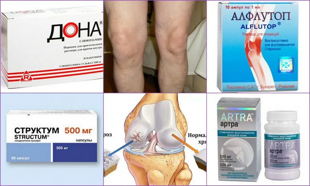 Что можно при болях в суставах. Таблетки уколы при артрозе коленного сустава. Таблетки лекарство от артроза суставов. Препарат от артроза коленного сустава таблетки. Таблетки для артроза коленного сустава.