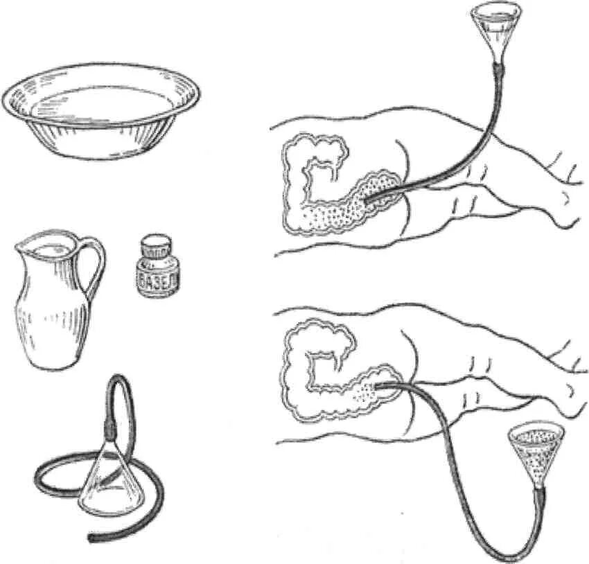 Техника постановки сифонной клизмы алгоритм. Постановка сифонной клизмы алгоритм. Сифонная клизма алгоритм. Постановка сифонной клизмы. Как делать клизму водой