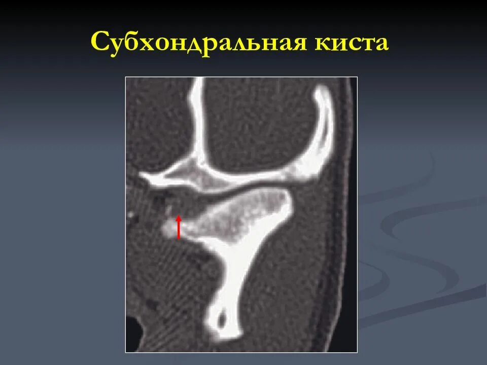 Аневризмальная костная киста большеберцовой кости. Болезнь кенига рентген. Киста головки бедренной кости кт. Хондробластома большеберцовой кости. Субхондральные кисты.