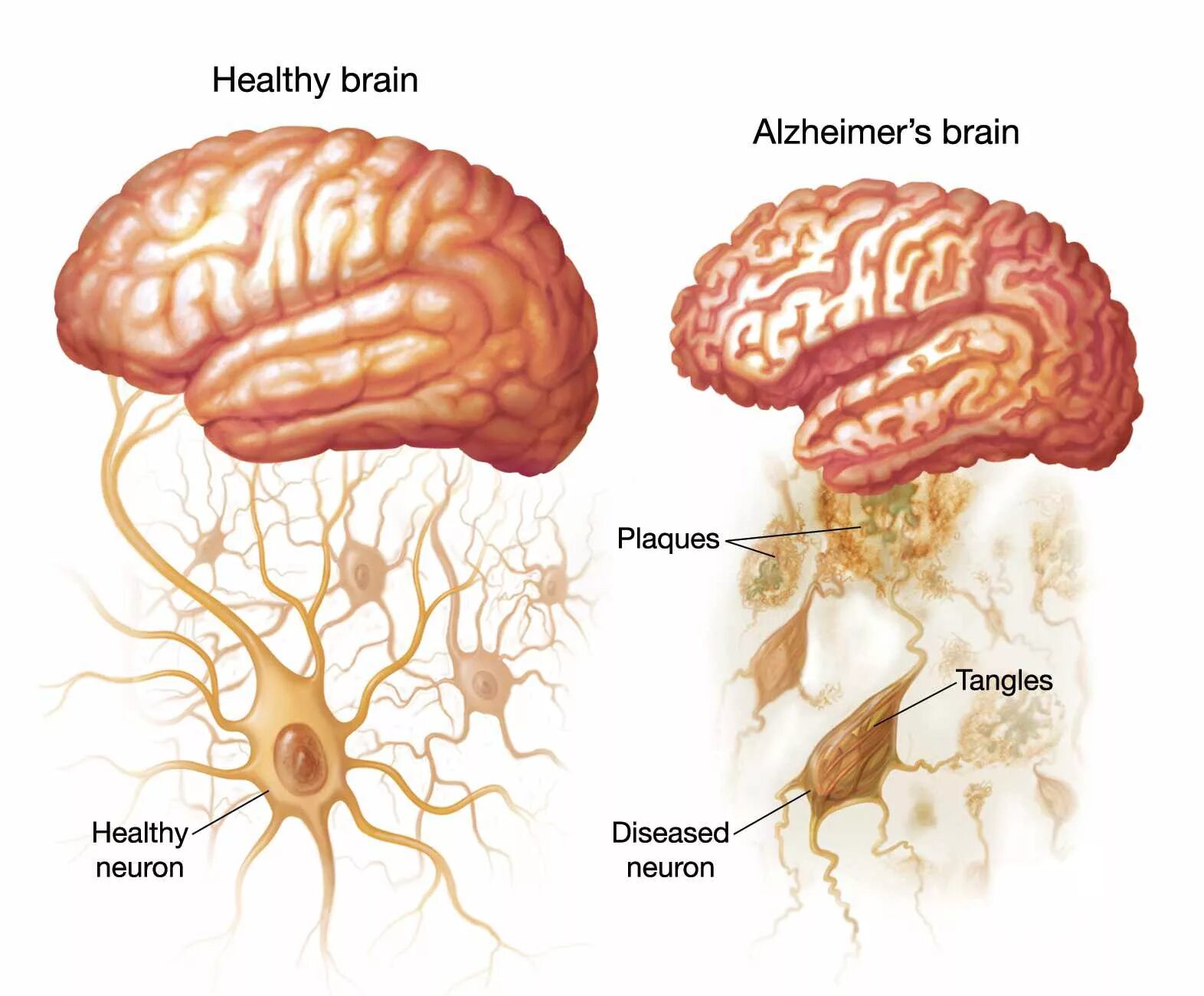 Brain disease. Болезнь Альцгеймера. Мозг больного Альцгеймером. Мозг больного деменцией. Головной мозг при альцгеймере.