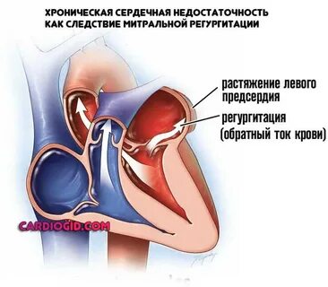 Пульмональная регургитация 1 степени что это такое
