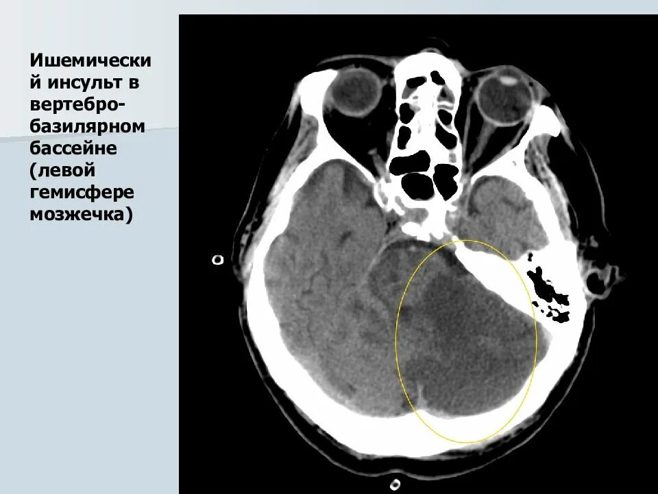 Вертебро базилярная инсульт. Ишемический инсульт мозжечка кт. Мозжечковый инсульт кт. Вертбазилярный бассейн кт. Вертебробазилярный бассейн на кт.