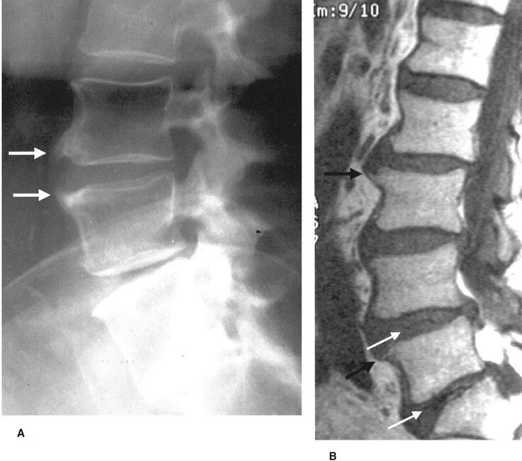 Остеохондроз поясничного отдела l4-l5. Мрт протрузии позвонков l5 s1. Грыжа диска l5-s1. Экструзия межпозвоночного диска l5-s1. Экструзия диска l5-s1 что это такое.