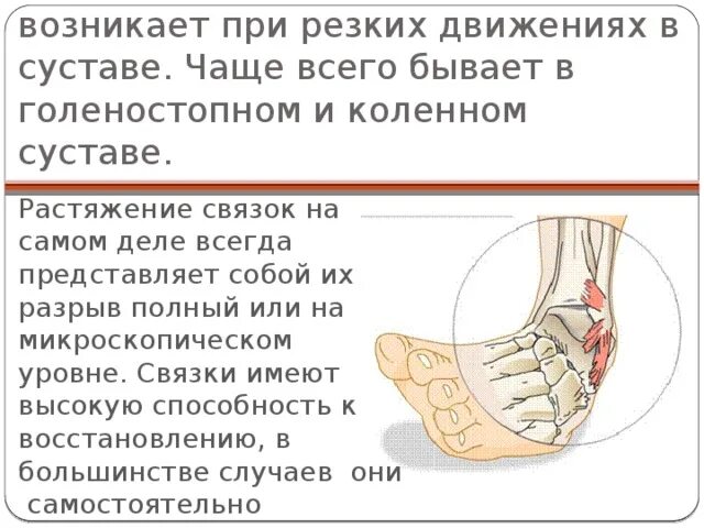 Растяжение связок голеностопного сустава. Движения в голеностопном суставе. При растяжении голеностопного сустава. Чаще всего происходят растяжения и разрывы связок:. Мкб 10 код растяжение связок голеностопного сустава