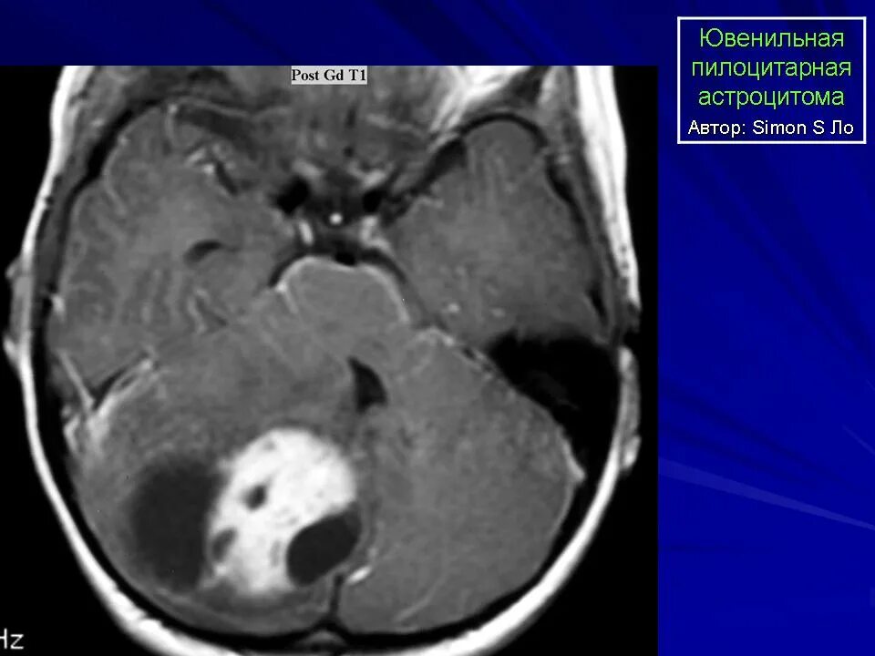 Пилоидная астроцитома. Ювенильная пилоцитарная астроцитома. Пилоидная астроцитома таламуса. Пилоидная астроцитома мрт. Пилоцитарная астроцитома мозжечка кт.