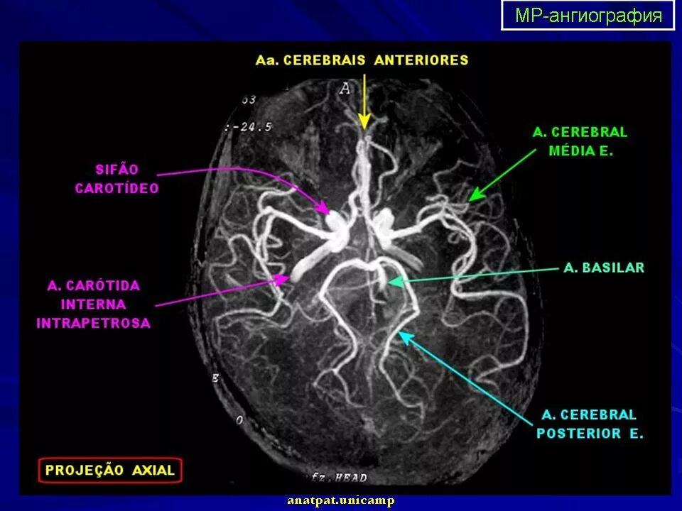 Задняя соединительная артерия мозга. Ангиография сосудов головного мозга анатомия. Анатомия сосудов мозга мрт. Кт ангиография аневризма головного мозга. Кт ангиография сосудов головного мозга анатомия.