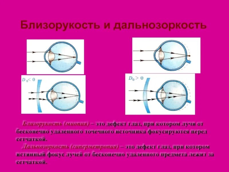 Дальнозоркость линзы двояковыпуклые. Близорукость и дальнозоркость. Глаз дальнозоркость и близорукость. Заболевания глаз близорукость и дальнозоркость. Близорукость и дальнозоркость оптика.