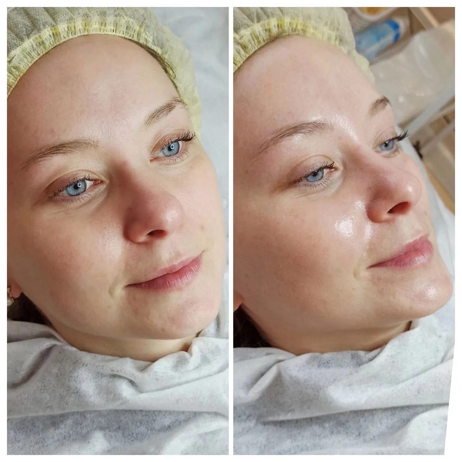 Карбоновый пилинг: цена TS.ESTETIC CLINIСA в Краснодаре
