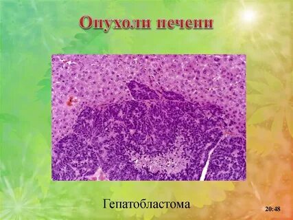 Гепатобластома