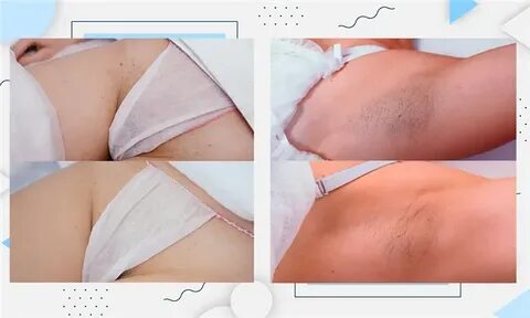 Эпиляциядан кейінгі кисканың фотосуреттері