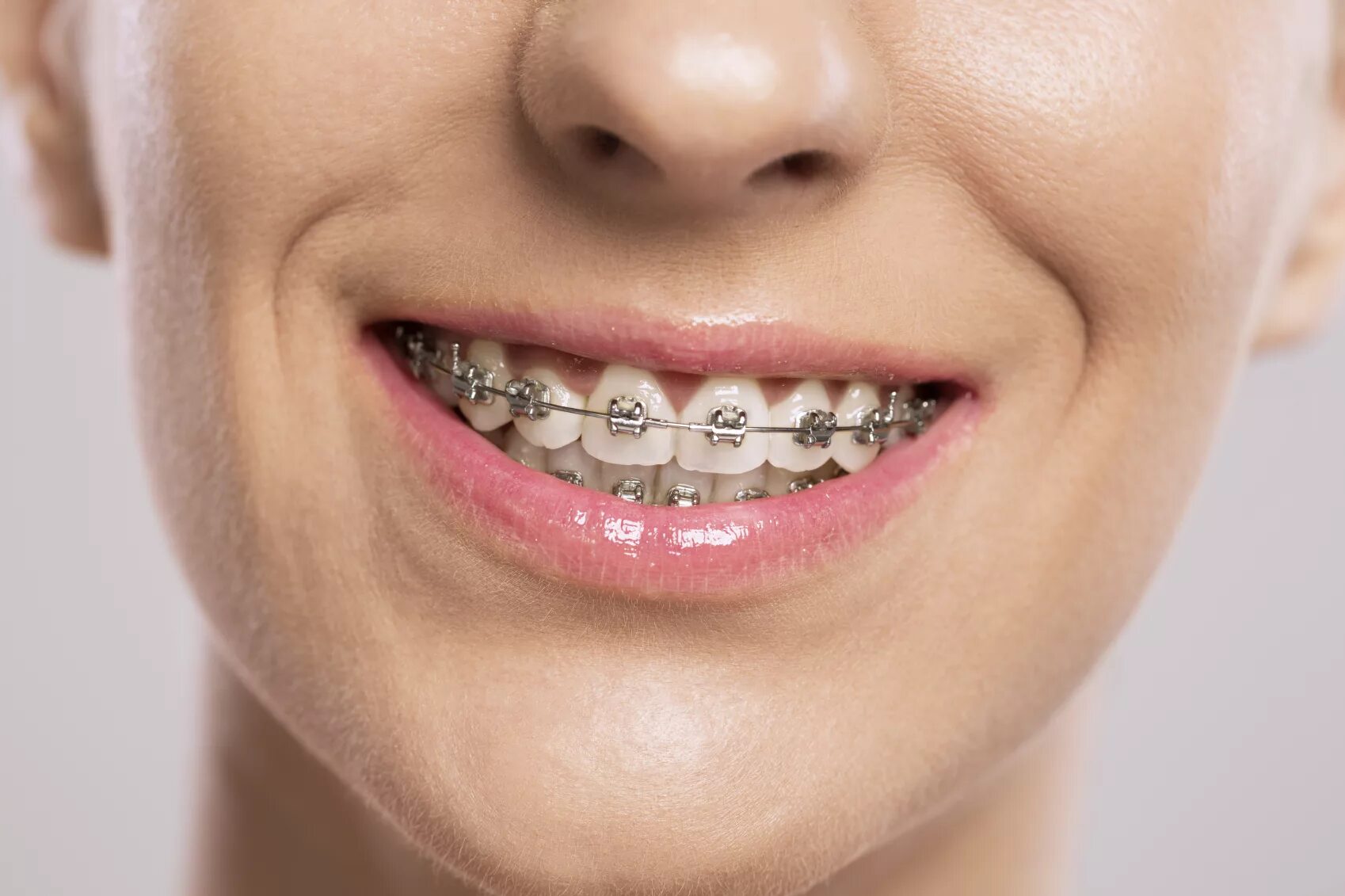 Брекеты Sia Orthodontic для детей. Брекеты для зубов металлические. Брекеты на зубы для детей сколько стоят