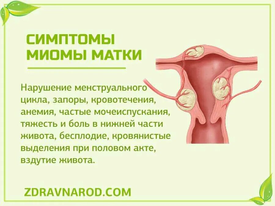 Миома матки симптомы и признаки. Клинические проявления миомы матки. Симптомы при миоме матки. Основные симптомы миомы матки.