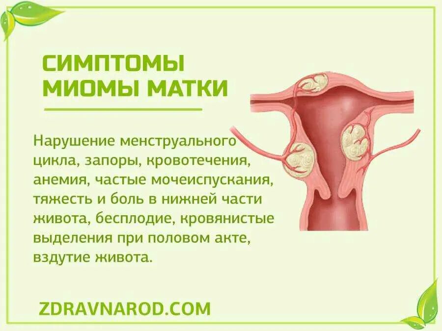 Миома чего бывает у женщин. Клинические проявления миомы матки. симптомная миома тела матки. симптомы при миоме матки. основные симптомы миомы матки.