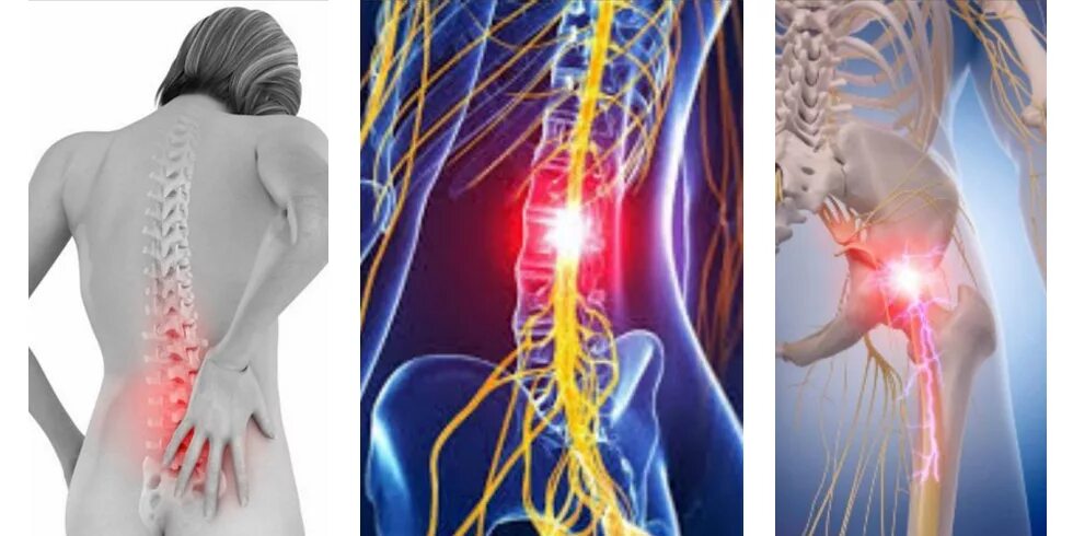Болит спина защемление. Пояснично-крестцовый радикулит. Радикулопатия l1. Радикулопатия л4-s1. Радикулит воспаление Корешков.