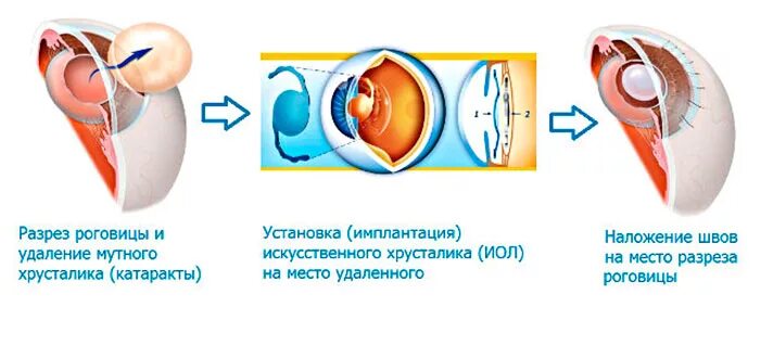 Операция катаракта замена хрусталика отзывы. Экстракапсулярная экстракция катаракты этапы операции. Интракапсулярная экстракция катаракты этапы. Экстракция увеальной катаракты. Этапы экстракапсулярной экстракции катаракты.