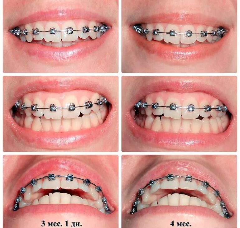 Сколько времени носят брекеты. Брекеты на нижних и верхних зубах.