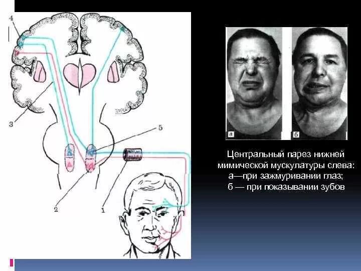 Порез лицевого. Парез мимической мускулатуры лицевого нерва. Периферический парез лицевого нерва. Паралич лицевого нерва неврология. Периферический паралич 12 ЧМН.