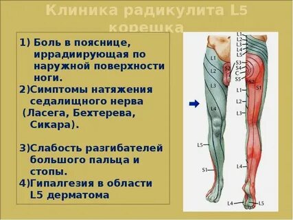 Радикулопатия l5