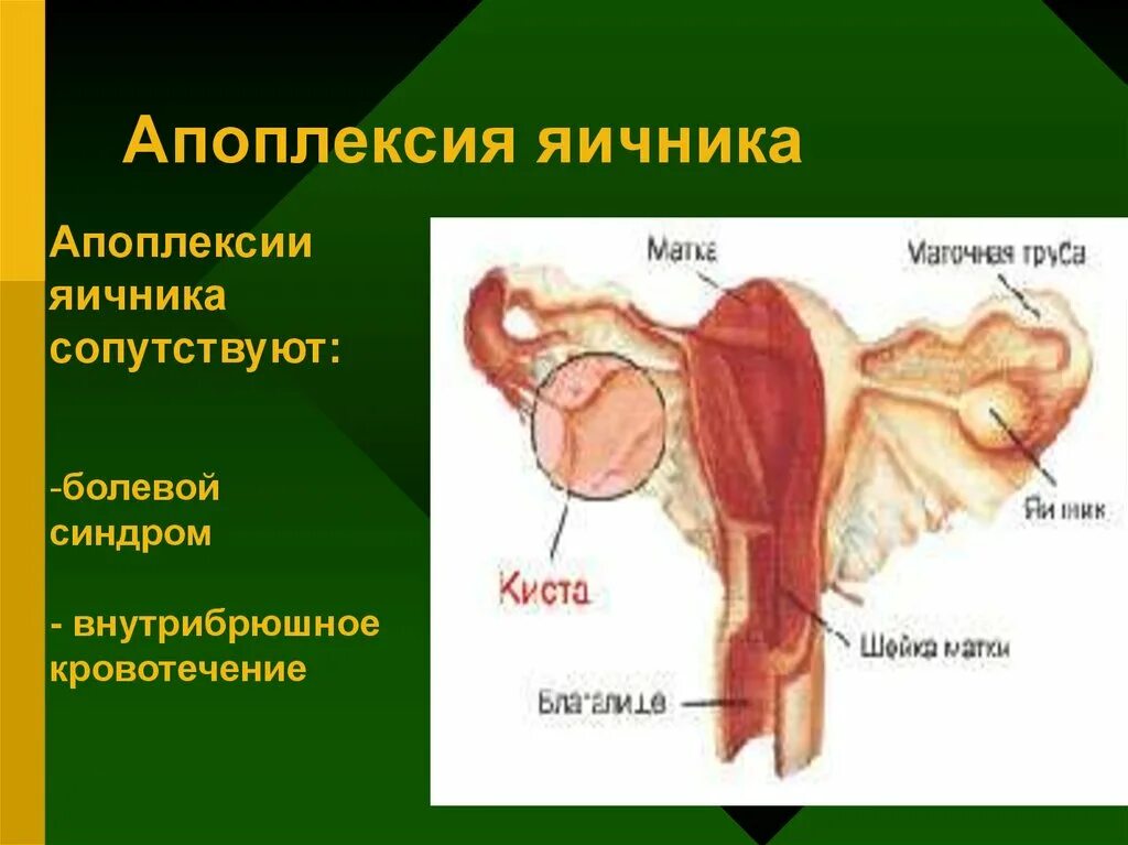 Болевая апоплексия яичника. Апоплексия правого яичника. Апоплексия кисты яичников.