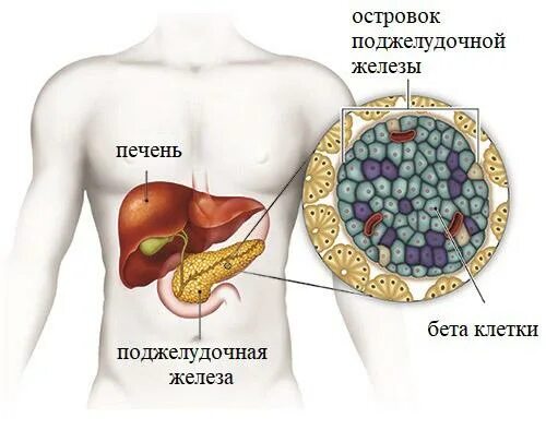 Камни в поджелудочная железа симптомы лечение. Инсулин продуцирующие опухоли поджелудочной. Инсулинома поджелудочной железы патанатомия. Конкременты поджелудочной железы. Сахарный диабет поджелудочная железа.