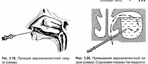 После пункции что делать
