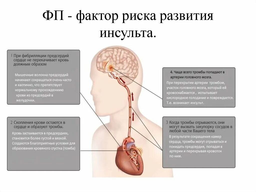 Факторы риска инсульта. Факторы развития инсульта. Факторы риска развития инсульта. Факторы риска при инсульте. Тромбы после инсульта