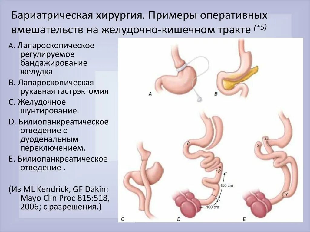 После операции по уменьшению желудка. Резекция желудка по гофмейстеру-Финстереру. Бариатрическая операция. Бариатрическая операция на желудке.